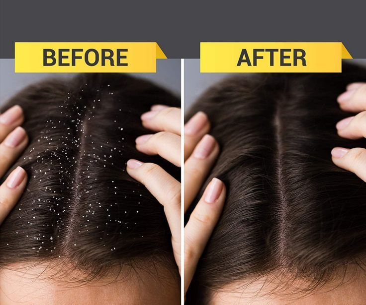 Anti-Dandruff Scalp Treatment