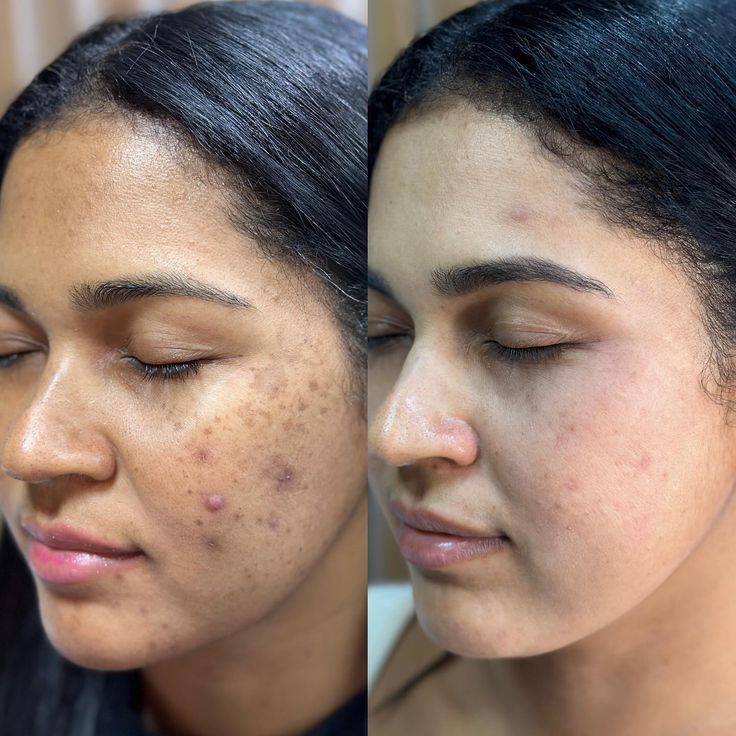 Acne Treatment Facial